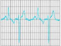 ECGs